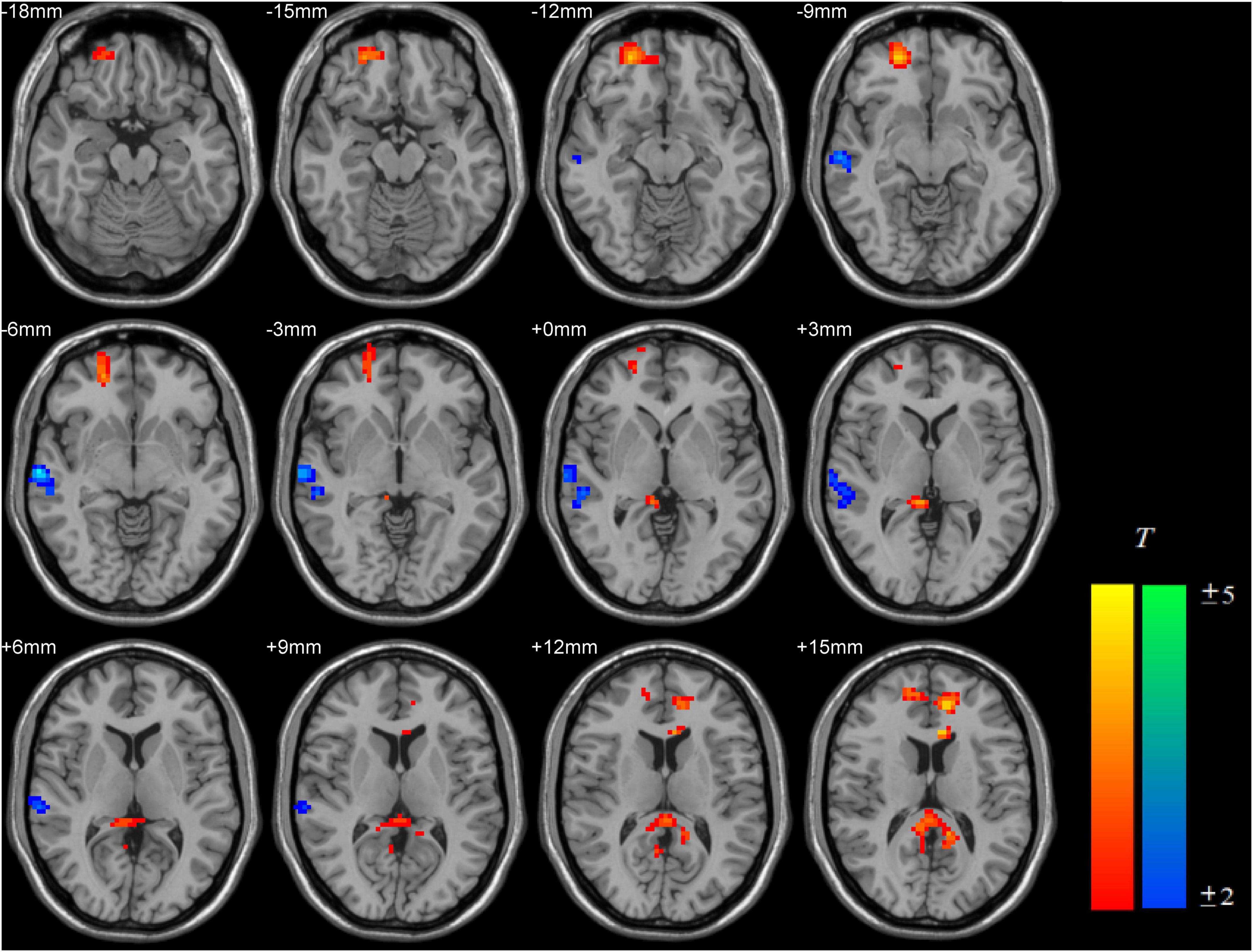 The involvement of spontaneous brain activity in natural recovery from internet gaming disorder: A resting-state fMRI study